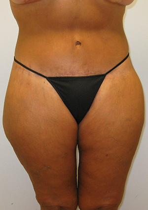 Buttock Lift Before & After Image