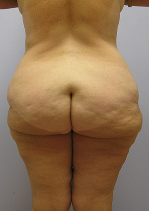 Buttock Lift Before & After Image