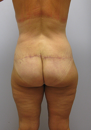 Buttock Lift Before & After Image