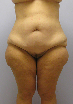 Buttock Lift Before & After Image