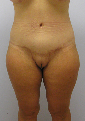 Buttock Lift Before & After Image