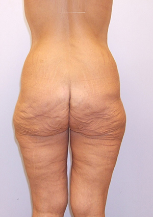 Buttock Lift Before & After Image