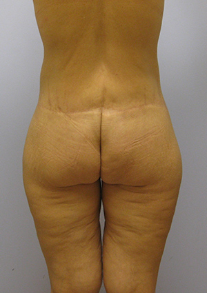 Buttock Lift Before & After Image