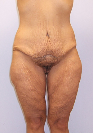 Buttock Lift Before & After Image