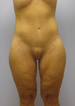 Buttock Lift Before & After Image