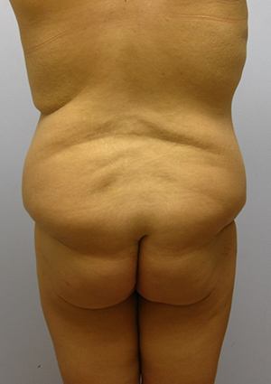 Buttock Lift Before & After Image