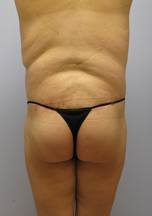 Buttock Lift Before & After Image