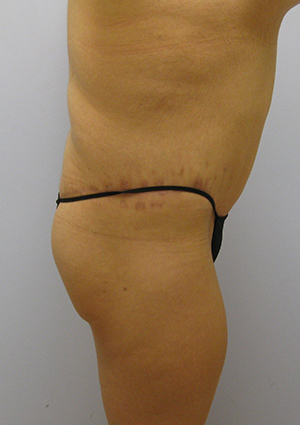 Buttock Lift Before & After Image