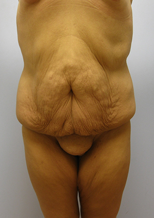 Buttock Lift Before & After Image