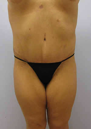 Buttock Lift Before & After Image