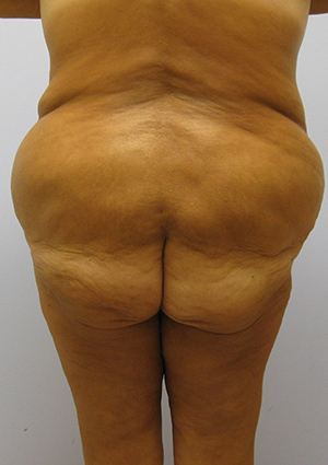 Buttock Lift Before & After Image