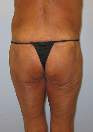 Buttock Lift Before & After Image