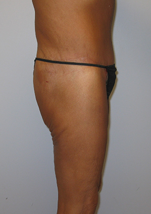 Buttock Lift Before & After Image