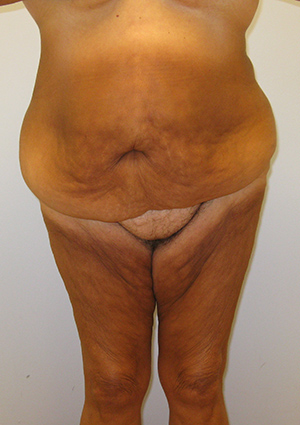 Buttock Lift Before & After Image