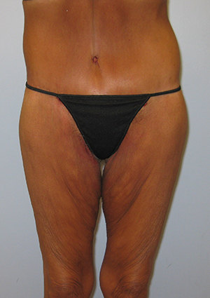 Buttock Lift Before & After Image