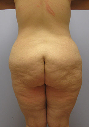 Buttock Lift Before & After Image