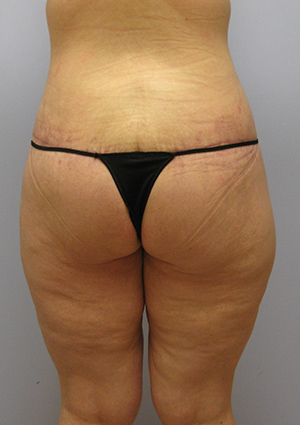 Buttock Lift Before & After Image