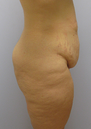 Buttock Lift Before & After Image