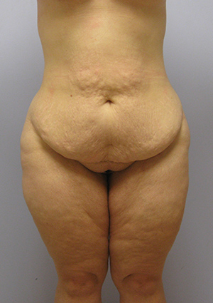 Buttock Lift Before & After Image