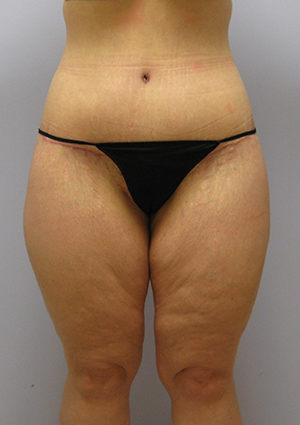 Buttock Lift Before & After Image