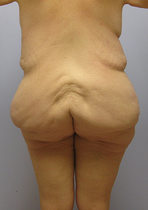 Buttock Lift Before & After Image