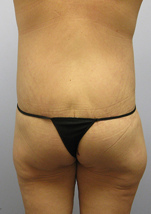 Buttock Lift Before & After Image