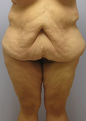 Buttock Lift Before & After Image