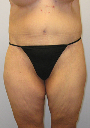 Buttock Lift Before & After Image