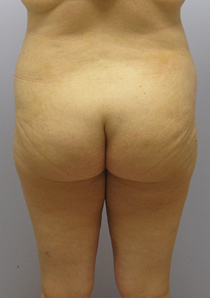 Buttock Lift Before & After Image