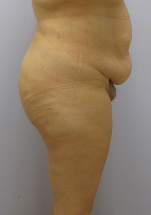 Buttock Lift Before & After Image