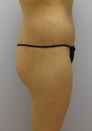 Buttock Lift Before & After Image