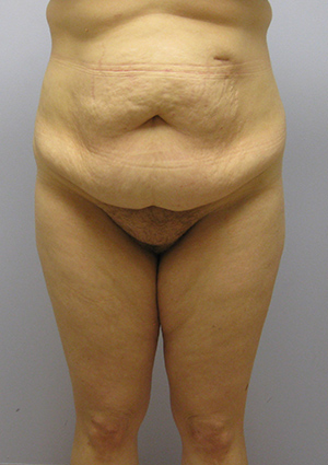 Buttock Lift Before & After Image