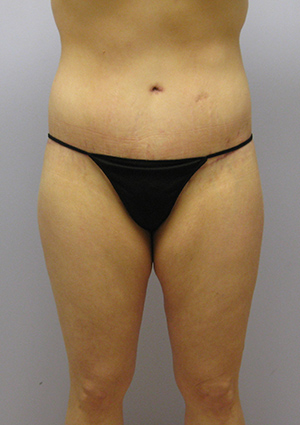 Buttock Lift Before & After Image