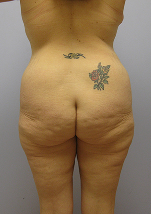 Buttock Lift Before & After Image