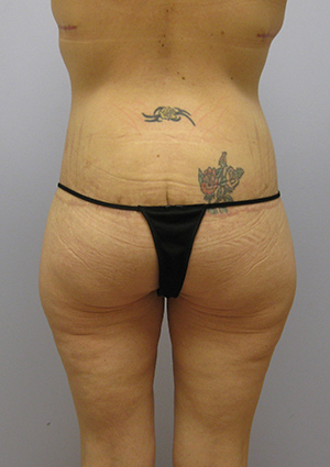 Buttock Lift Before & After Image