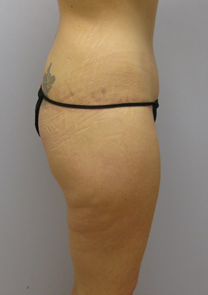 Buttock Lift Before & After Image