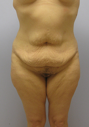 Buttock Lift Before & After Image