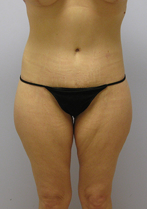 Buttock Lift Before & After Image