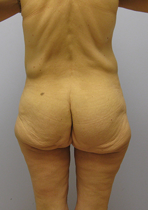 Buttock Lift Before & After Image