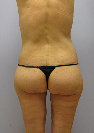 Buttock Lift Before & After Image