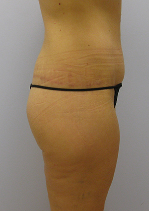 Buttock Lift Before & After Image