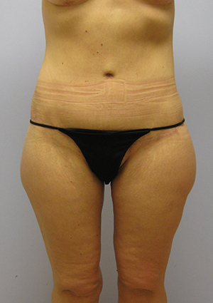 Buttock Lift Before & After Image