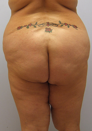 Buttock Lift Before & After Image