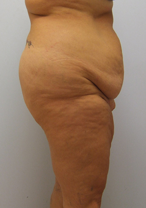 Buttock Lift Before & After Image