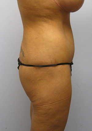 Buttock Lift Before & After Image