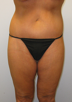 Buttock Lift Before & After Image