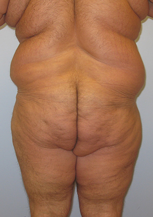 Buttock Lift Before & After Image