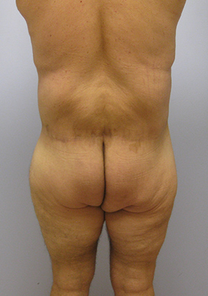 Buttock Lift Before & After Image