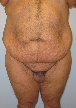 Buttock Lift Before & After Image