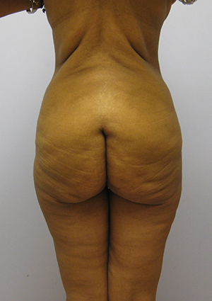 Buttock Lift Before & After Image